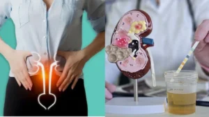 Bladder Cancer Urine Test: यूरिन टेस्ट से 90% से अधिक ब्लैडर कैंसर मामलों की पहचान, जानें नई रिसर्च, लक्षण और बचाव